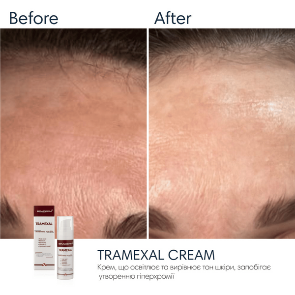 Крем проти пігментації Braderm Tramexal Cream, 30 мл 110024 фото