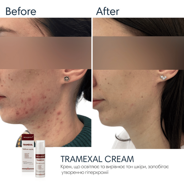 Крем проти пігментації Braderm Tramexal Cream, 30 мл 110024 фото