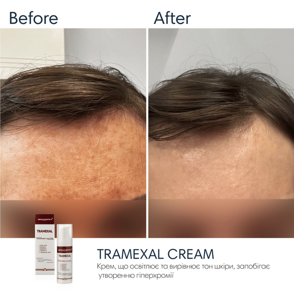 Крем проти пігментації Braderm Tramexal Cream, 30 мл 110024 фото