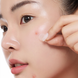 Патчі з мигдальною кислотою від висипань та постакне BY WISHTREND Mandelic Acid Spot Clearing Patch, 39 шт 11001130 фото 2