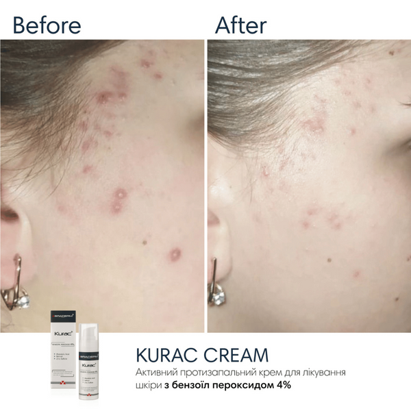 Нічний крем з бензоїл пероксидом Braderm Kurac Cream, 30 мл 110025 фото