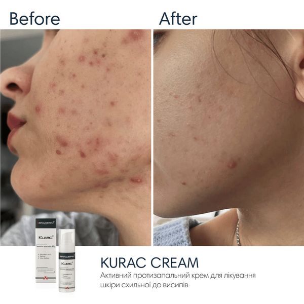 Нічний крем з бензоїл пероксидом Braderm Kurac Cream, 30 мл 110025 фото