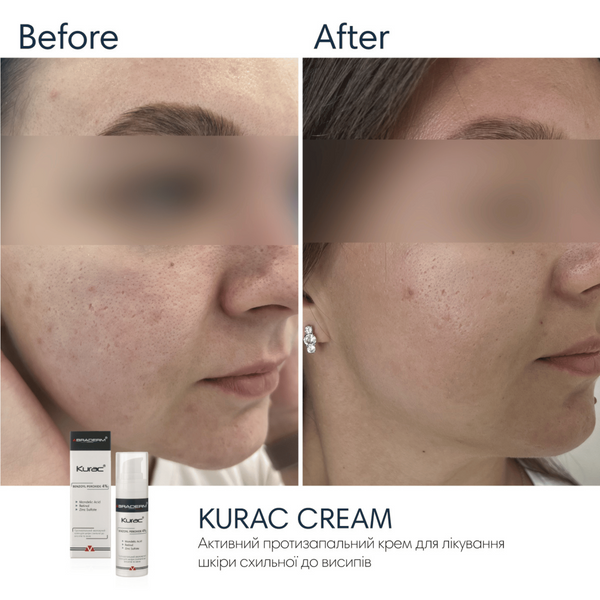 Нічний крем з бензоїл пероксидом Braderm Kurac Cream, 30 мл 110025 фото