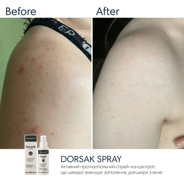 Спрей-концентрат для тіла з бензоїл пероксидом Braderm Dorsak Spray, 100 мл 110022 фото