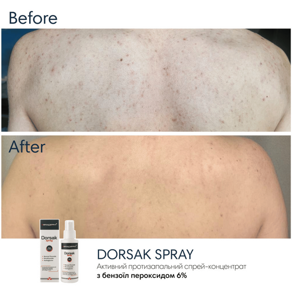 Спрей-концентрат для тіла з бензоїл пероксидом Braderm Dorsak Spray, 100 мл 110022 фото