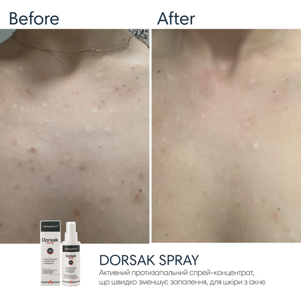 Спрей-концентрат для тіла з бензоїл пероксидом Braderm Dorsak Spray, 100 мл 110022 фото