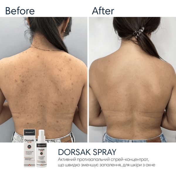 Спрей-концентрат для тіла з бензоїл пероксидом Braderm Dorsak Spray, 100 мл 110022 фото